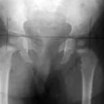 Justiça limita ressarcimento do SUS em cirurgia de R$ 239 mil